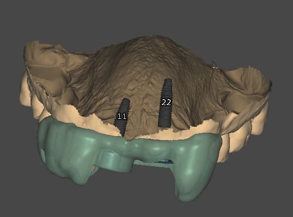 Render 3D de guía quirúrgica en mandíbula